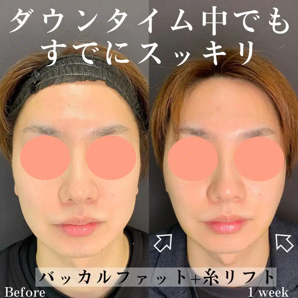 バッカルファット+糸リフト 大阪梅田
