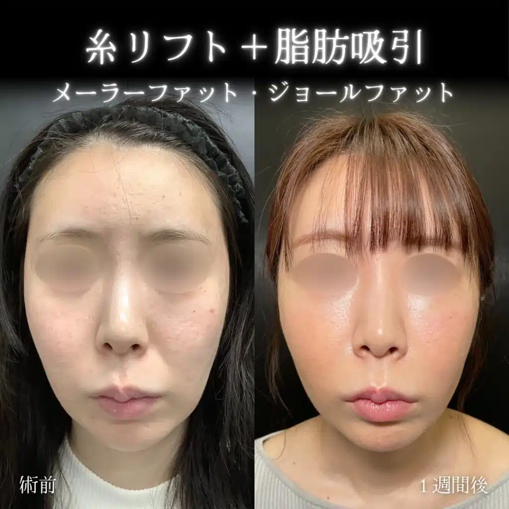 糸リフト+脂肪吸引 大阪梅田