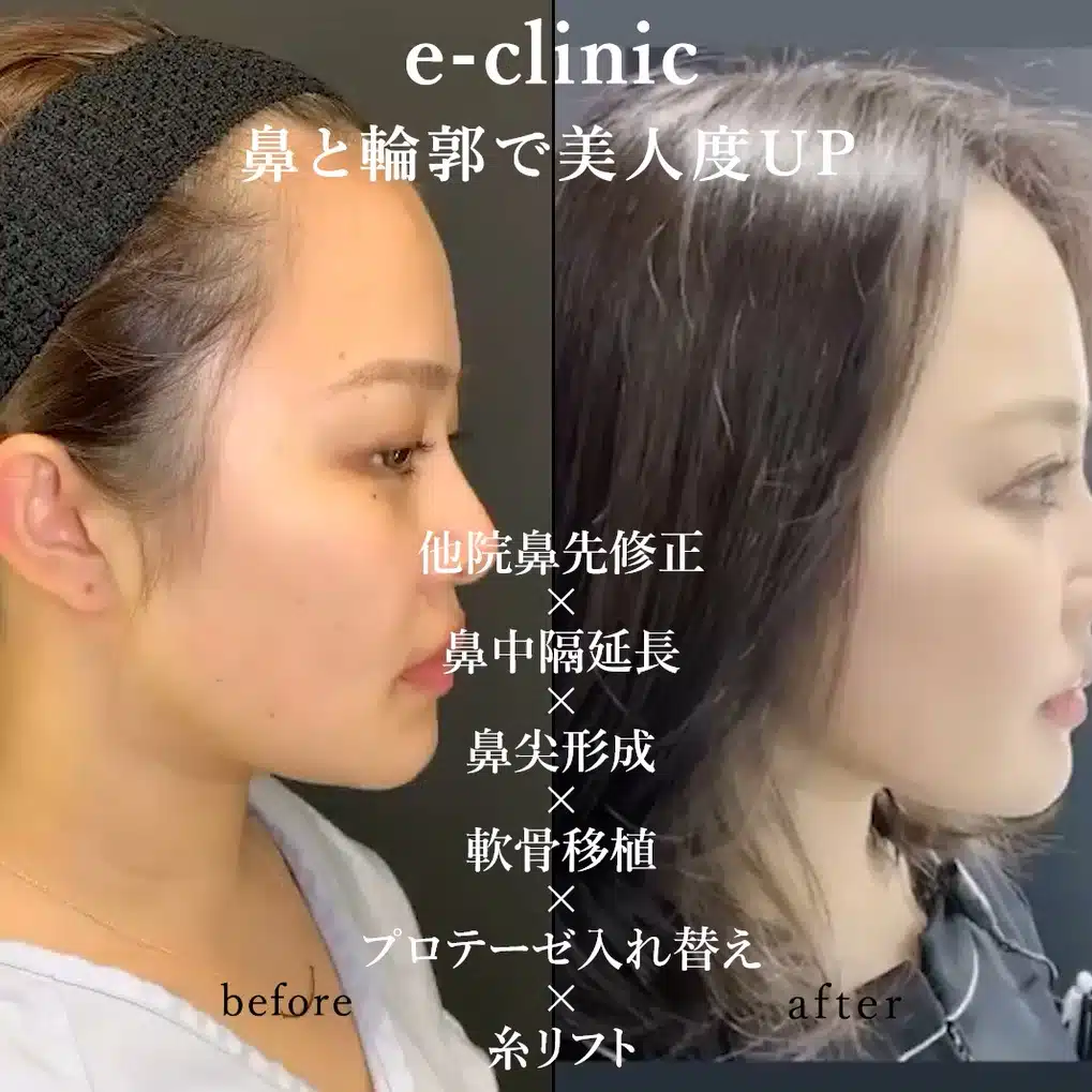 他院鼻先修正×鼻中隔延長×鼻尖形成×軟骨移植×プロテーゼ入れ替え×糸リフト　大阪梅田