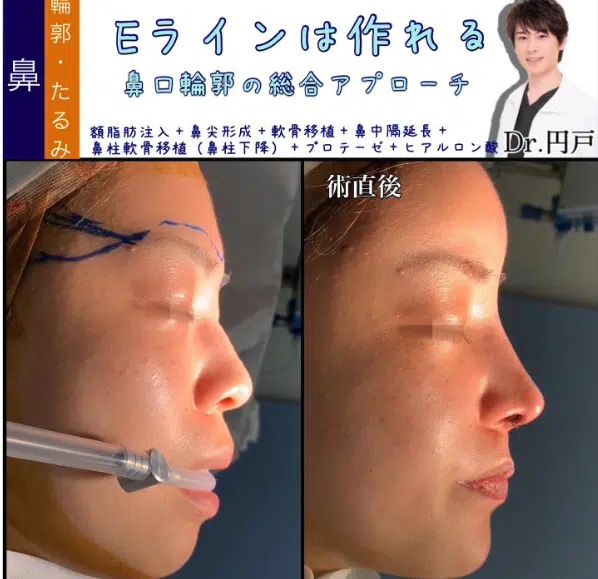 額脂肪注入+鼻尖形成+軟骨移植+鼻中隔延長+鼻柱軟骨移植（鼻柱下降）+プロテーゼ+ヒアルロン酸　大阪梅田