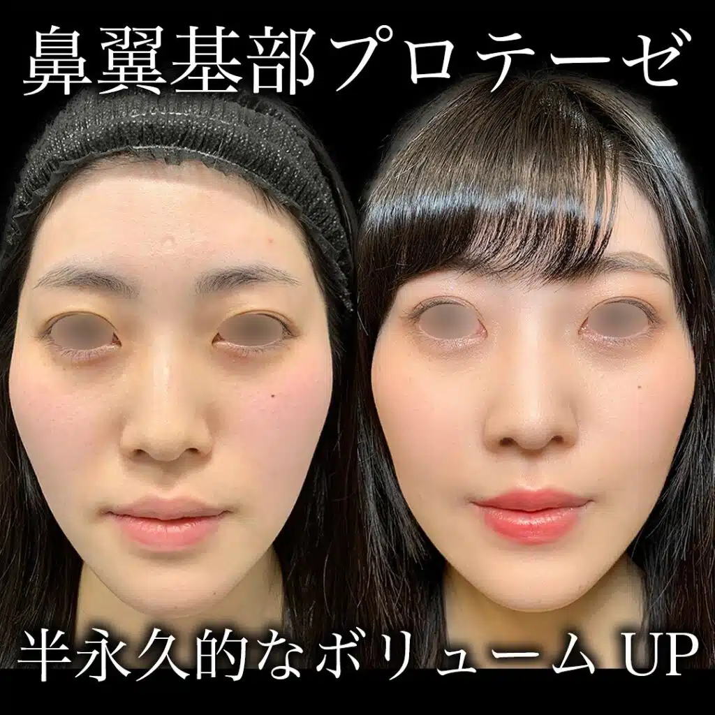 鼻翼基部プロテーゼ　大阪梅田