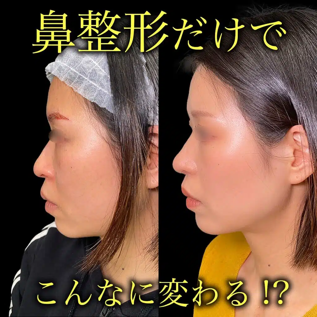 鼻尖形成と耳介軟骨移植と小鼻縮小　大阪梅田