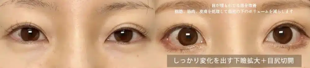 しっかり変化を出す下瞼拡大＋目尻切開　大阪梅田