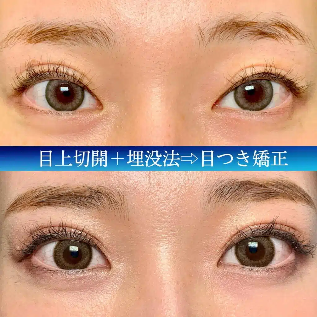 目上切開+埋没法　大阪梅田