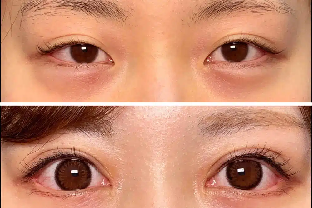 目尻切開＋目頭切開　大阪梅田