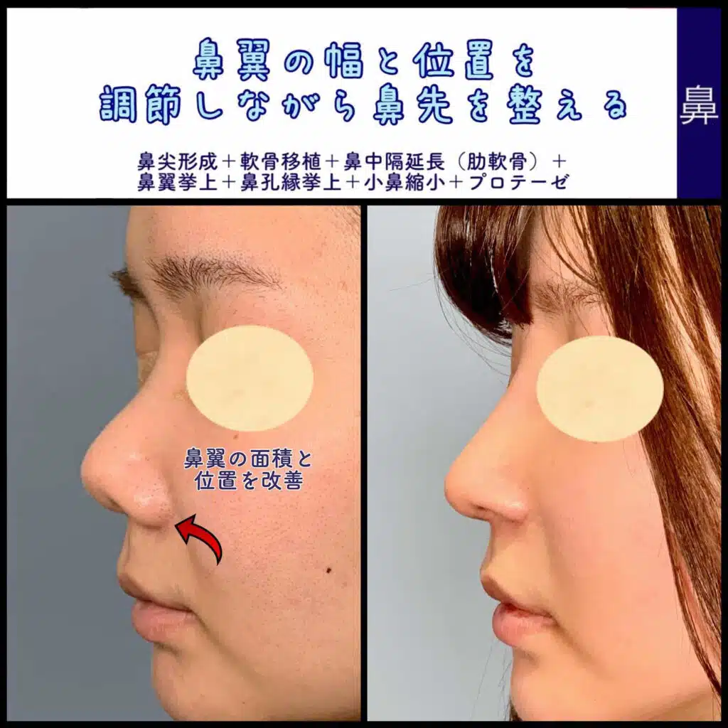 鼻尖形成+軟骨移植+鼻中隔延長（肋軟骨）+鼻翼挙上+鼻孔縁挙上+小鼻縮小+プロテーゼ　大阪梅田