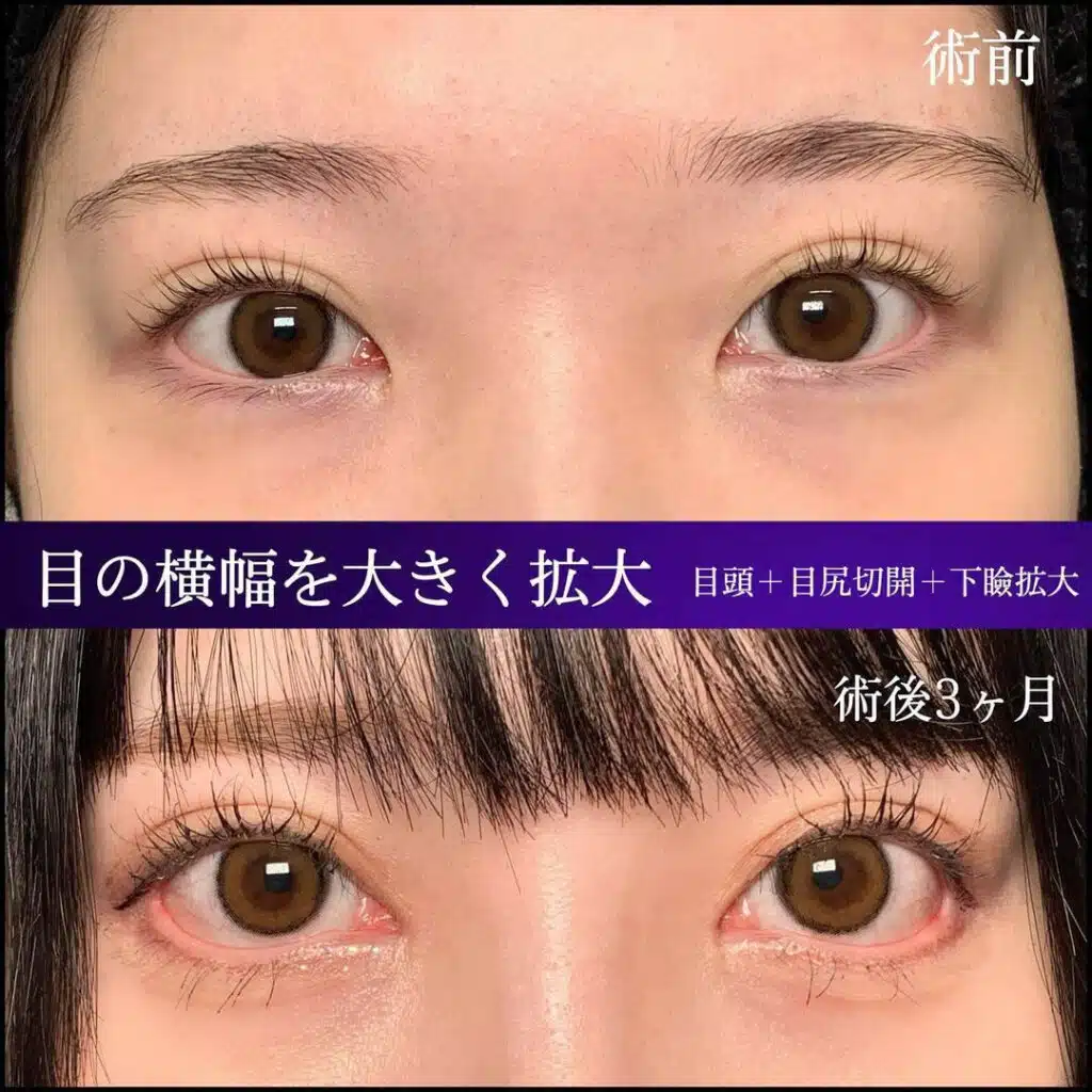 目頭＋目尻切開＋下瞼拡大　大阪梅田
