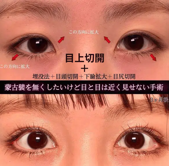 目上切開+埋没法+目頭切開+下瞼拡大+目尻切開　大阪梅田
