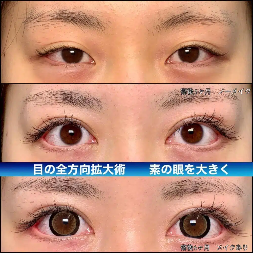 目の全方向拡大術　大阪梅田