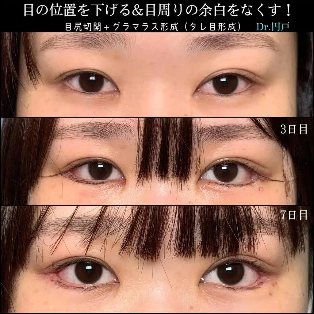 目尻切開＋グラマラス形成（タレ目形成）　大阪梅田