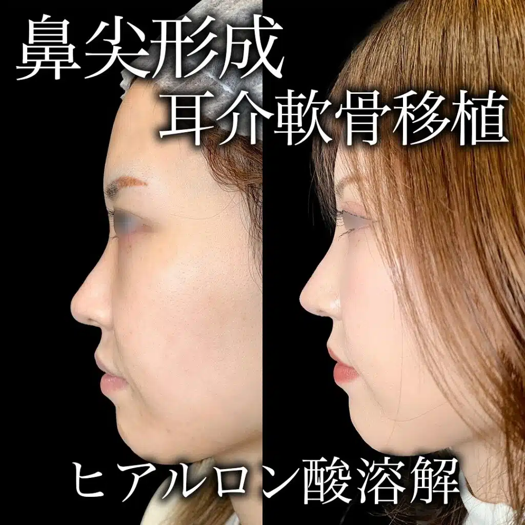 鼻尖形成と耳介軟骨移植　大阪梅田