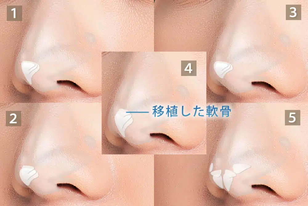 鼻尖軟骨移植の5つのパターン　大阪梅田