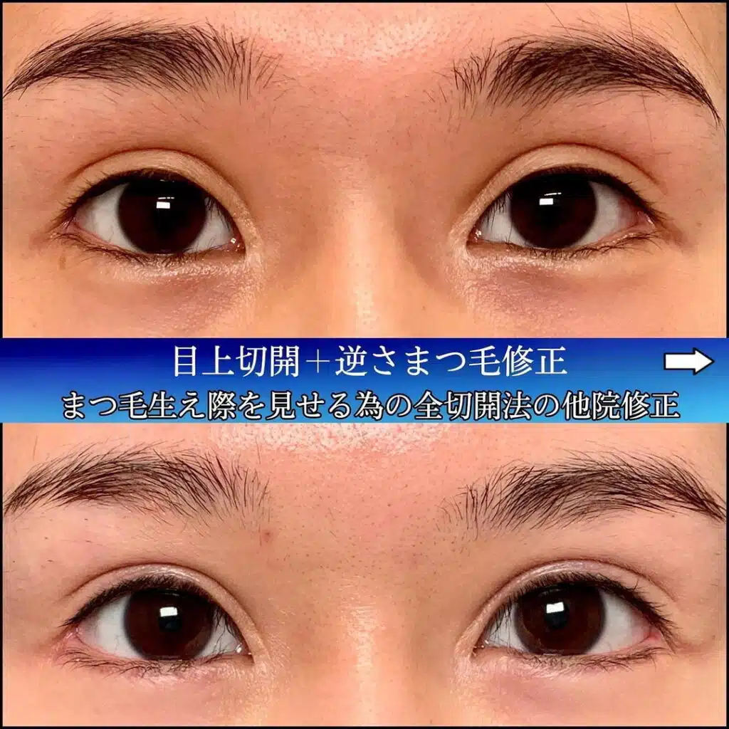 目上切開+逆さまつ毛修正　大阪梅田
