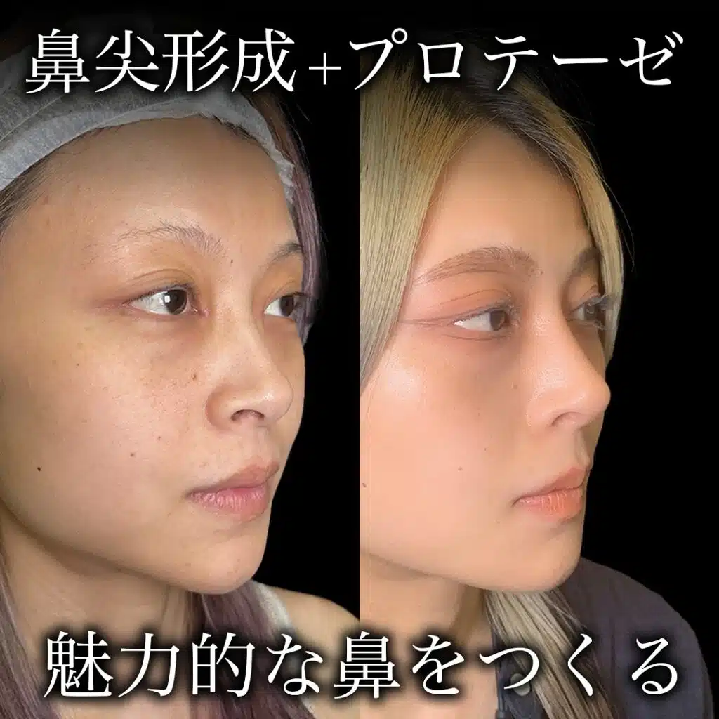 鼻尖形成+プロテーゼ　大阪梅田