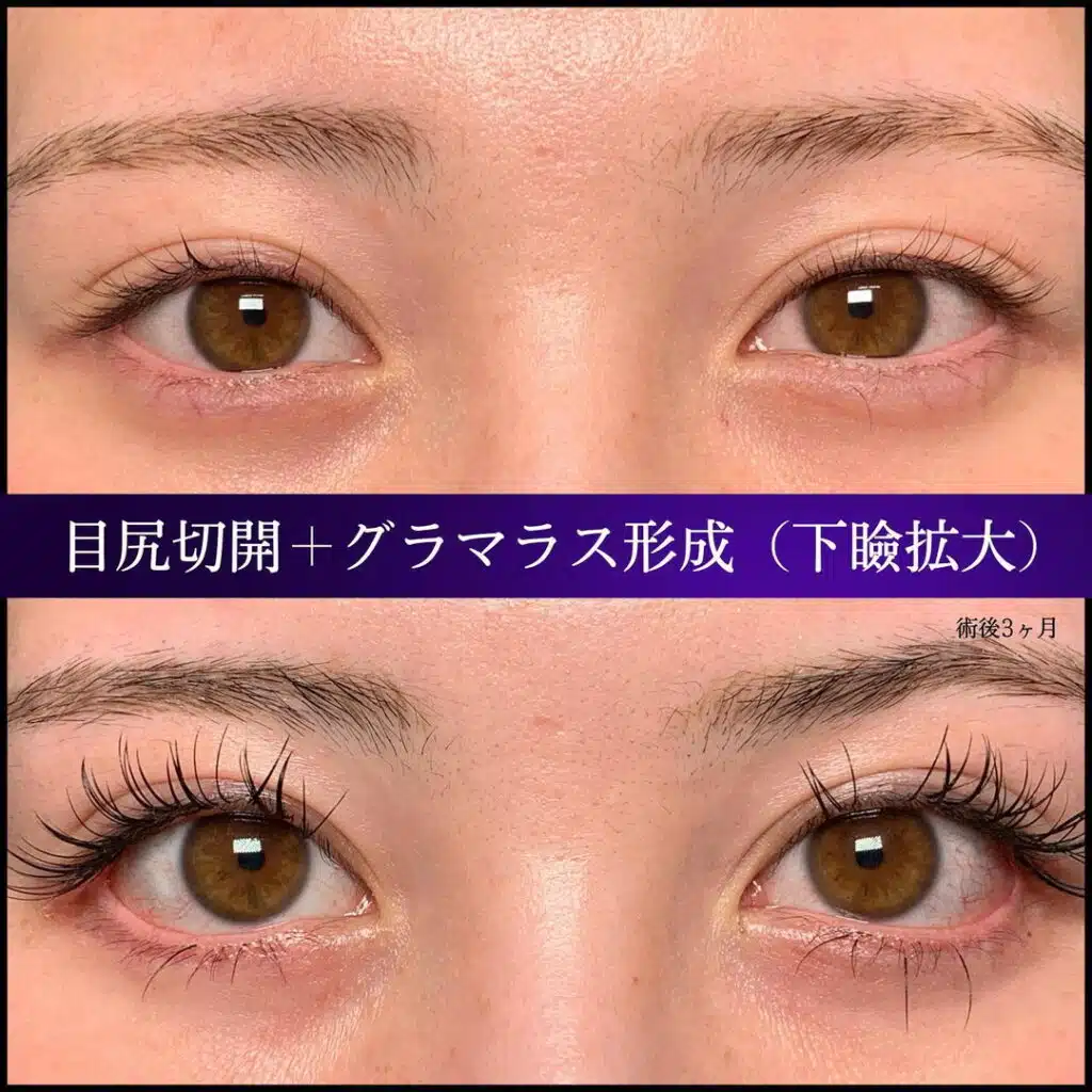 目尻切開＋グラマラス形成（下瞼形成）　大阪梅田
