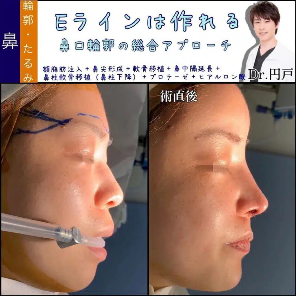 額脂肪注入+鼻尖形成+軟骨移植+鼻中隔延長+鼻柱軟骨移植（鼻柱下降）+プロテーゼ+ヒアルロン酸　大阪梅田