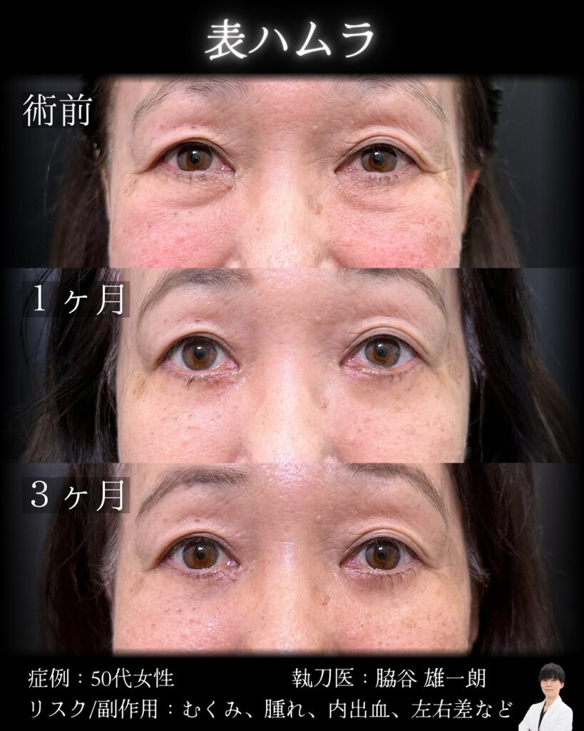 表ハムラ法の症例写真