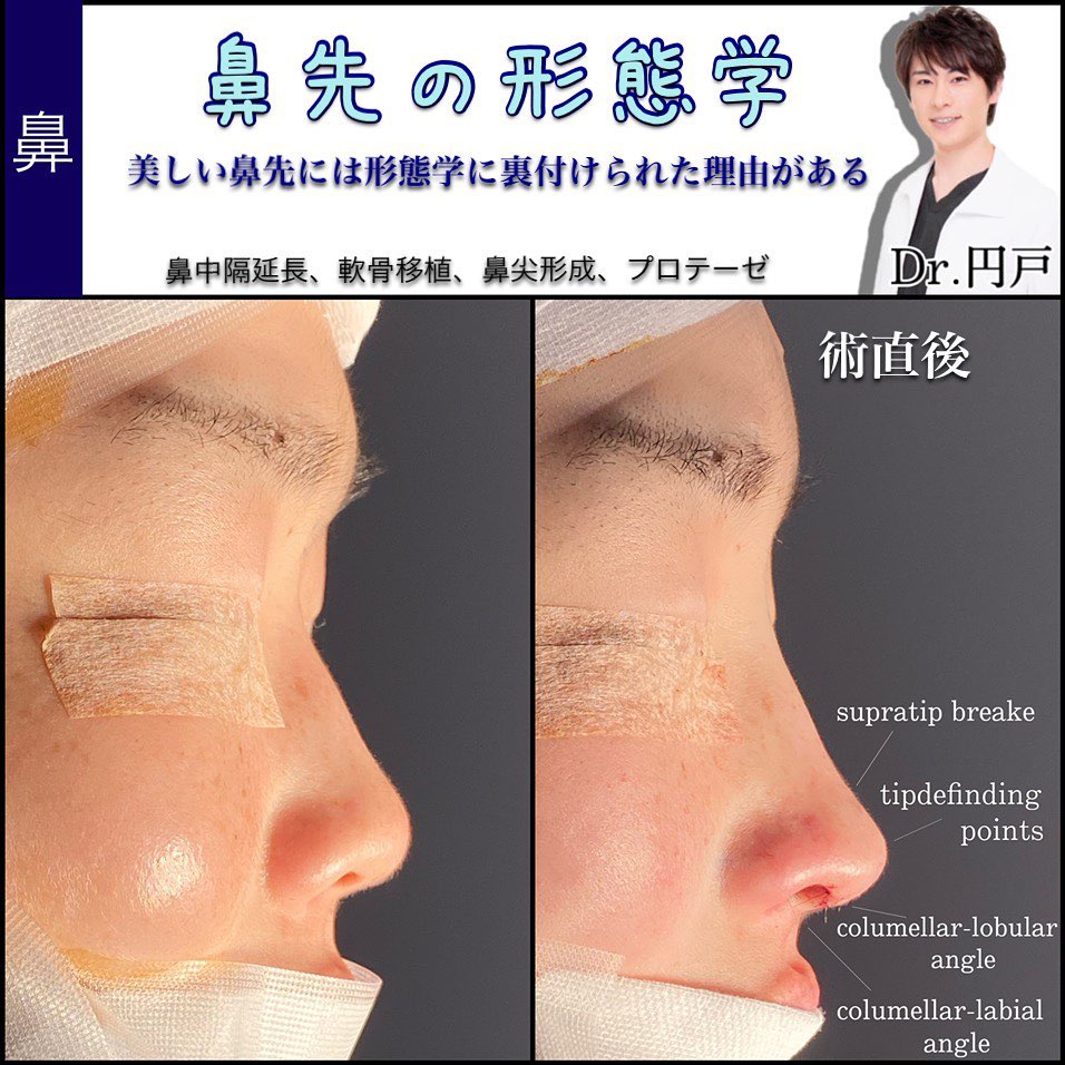 鼻尖形成と軟骨移植と鼻中隔延長と鼻翼挙上と鼻孔縁挙上と小鼻縮小とプロテーゼの症例写真-2-