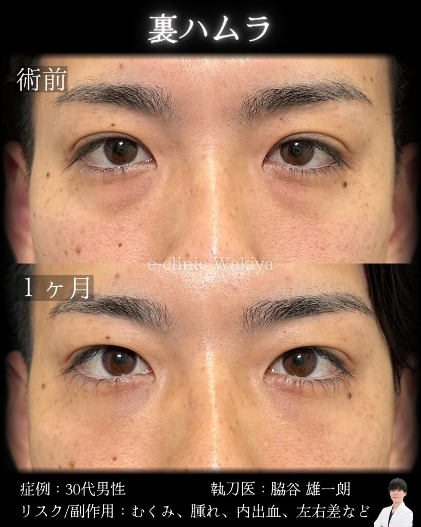裏ハムラ法の症例写真 (4)