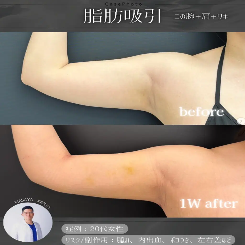 脂肪吸引　二の腕+肩+ワキ　大阪梅田
