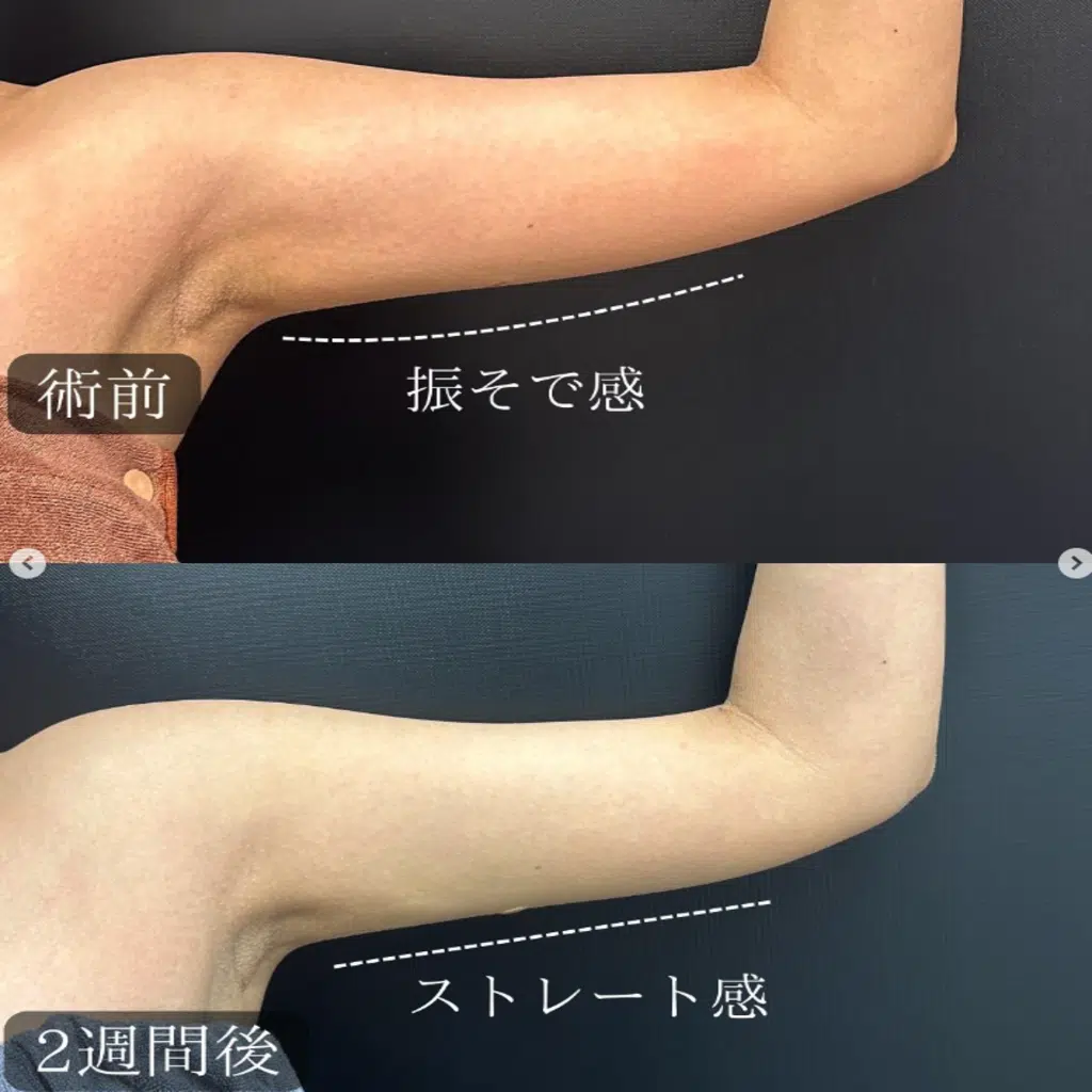 二の腕の脂肪吸引　大阪梅田