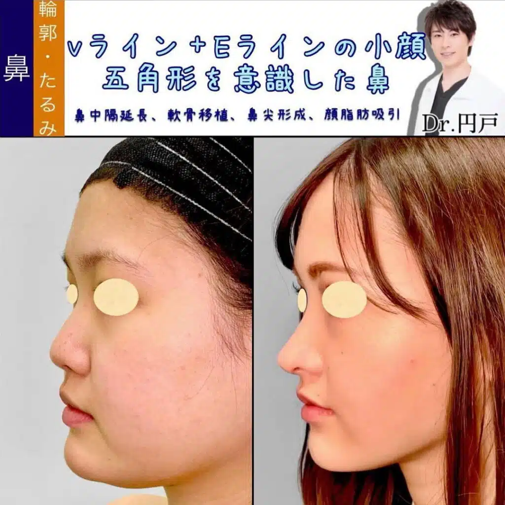 鼻中隔延長、軟骨移植、鼻尖形成、顔脂肪吸引　大阪梅田