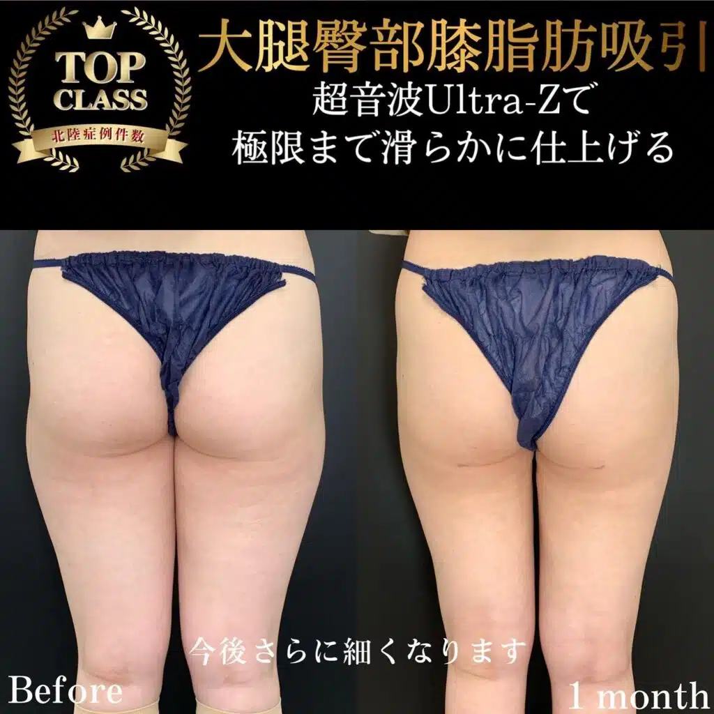 大腿臀部膝脂肪吸引　大阪梅田