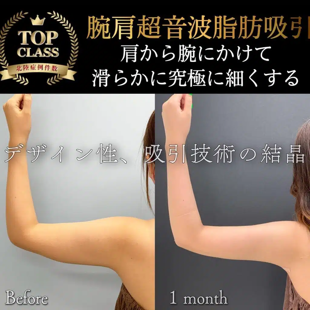 腕肩超音波脂肪吸引　大阪梅田