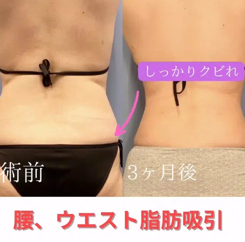 腰、ウエスト脂肪吸引　大阪梅田