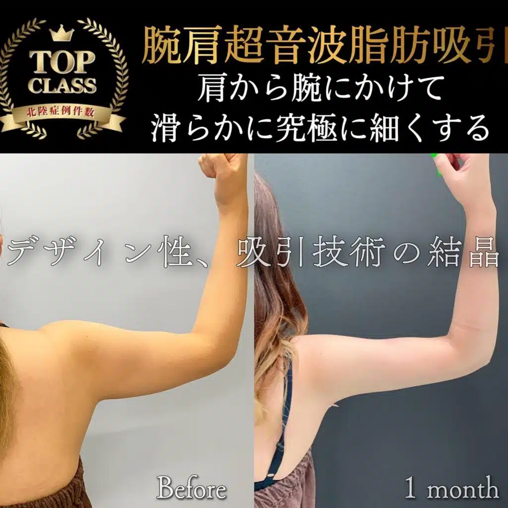 腕肩超音波脂肪吸引　大阪梅田