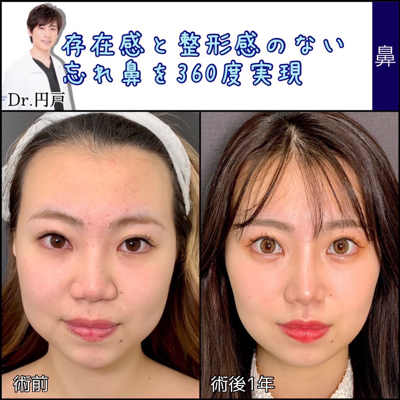 鼻尖形成と軟骨移植と鼻中隔延長と法令線基部人口真皮と鼻背部軟骨と小鼻縮小の症例写真