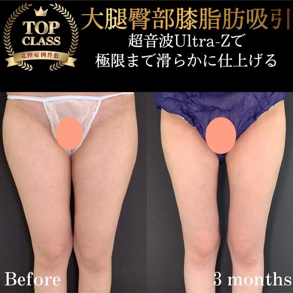 大腿臀部膝脂肪吸引　大阪梅田