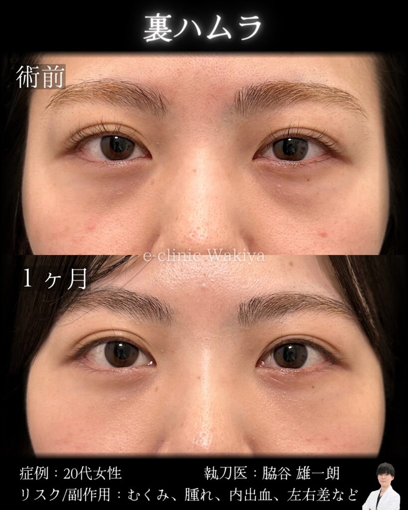 裏ハムラ法の症例写真 (5)