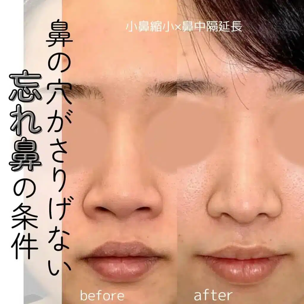 小鼻縮小×鼻中隔延長　大阪梅田