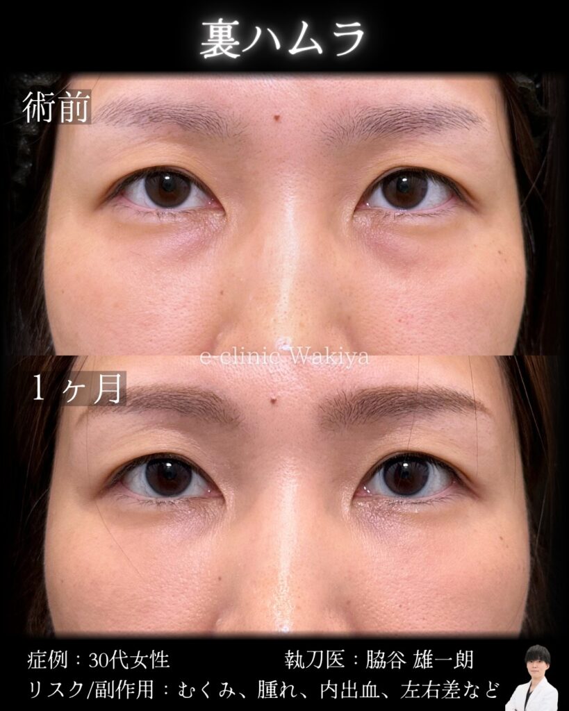 裏ハムラ法の症例写真 (2)