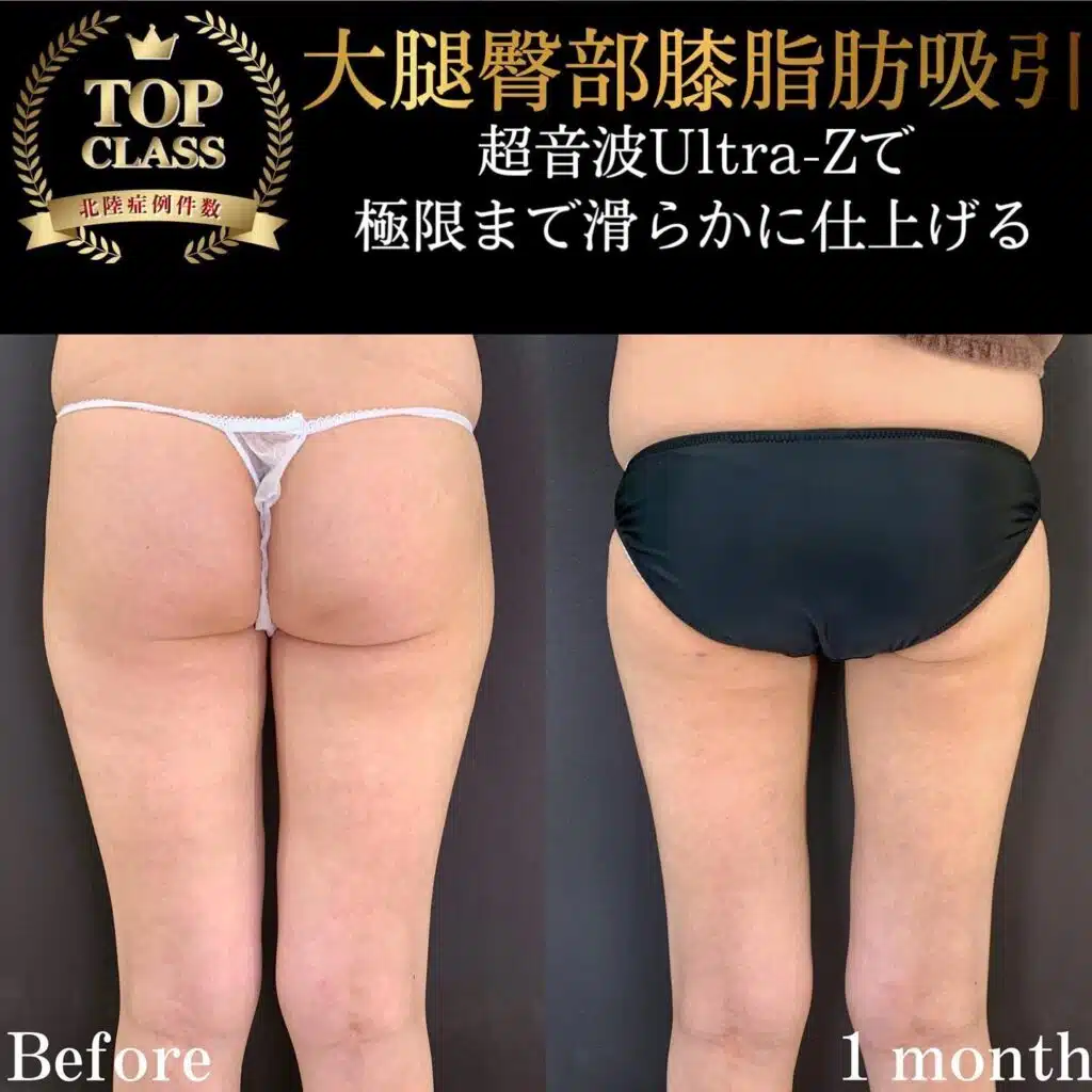 大腿臀部膝脂肪吸引　大阪梅田