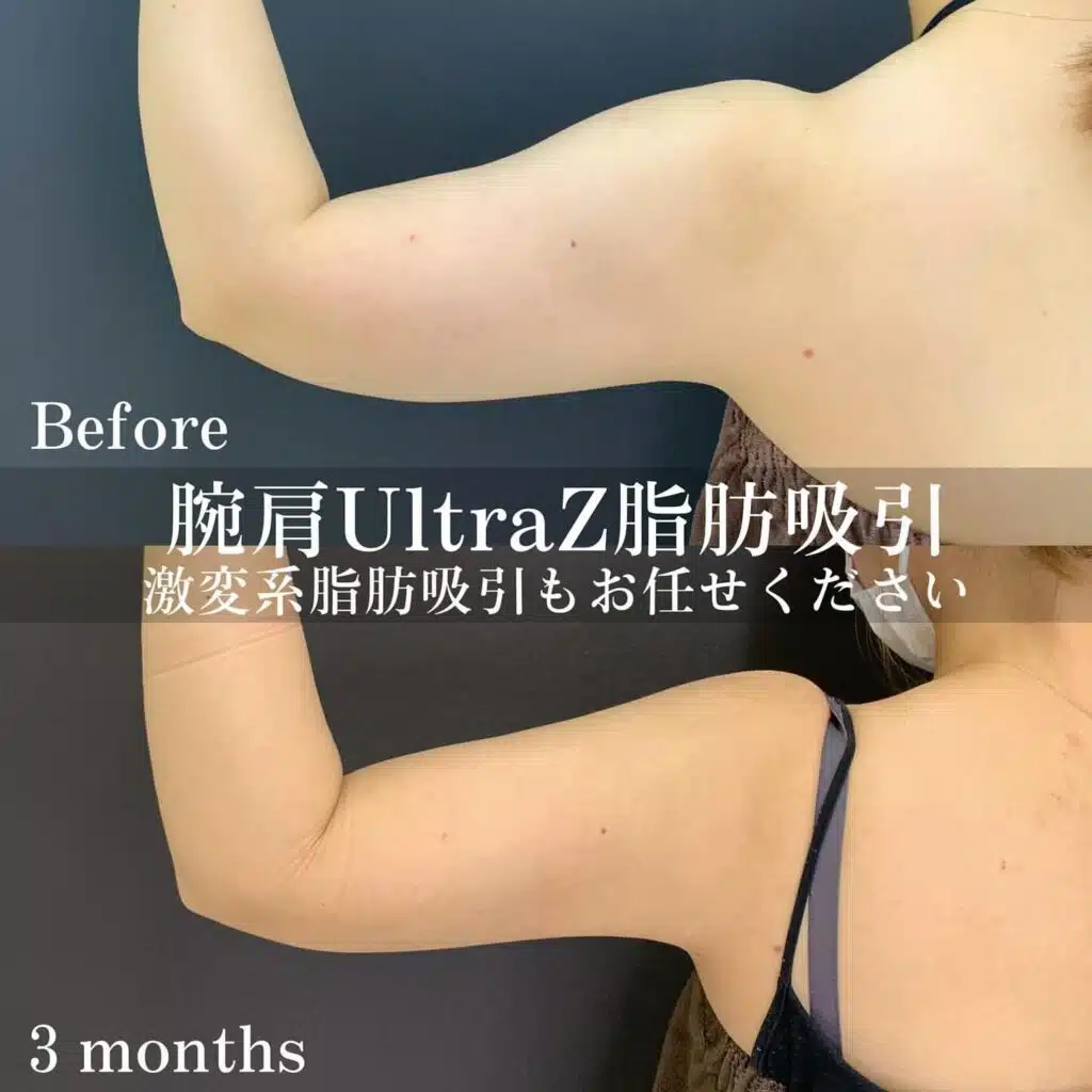 腕肩UltraZ脂肪吸引　大阪梅田