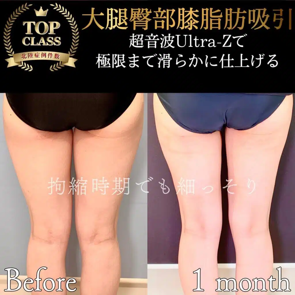 大腿臀部膝脂肪吸引　大阪梅田