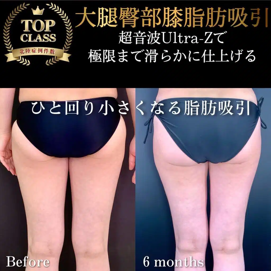 大腿臀部膝脂肪吸引　大阪梅田