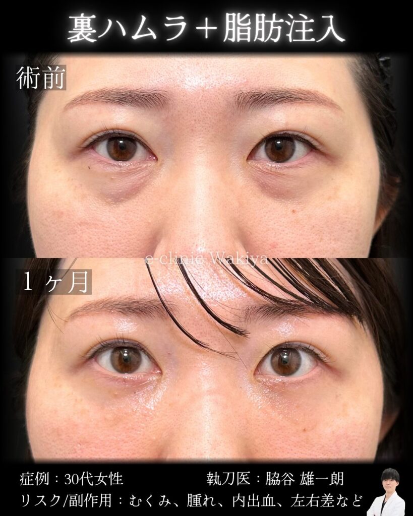 裏ハムラ法と脂肪注入の症例写真