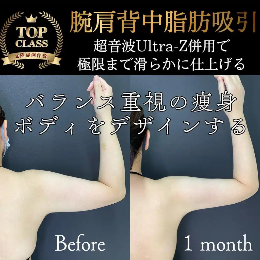 腕肩背中脂肪吸引　大阪梅田