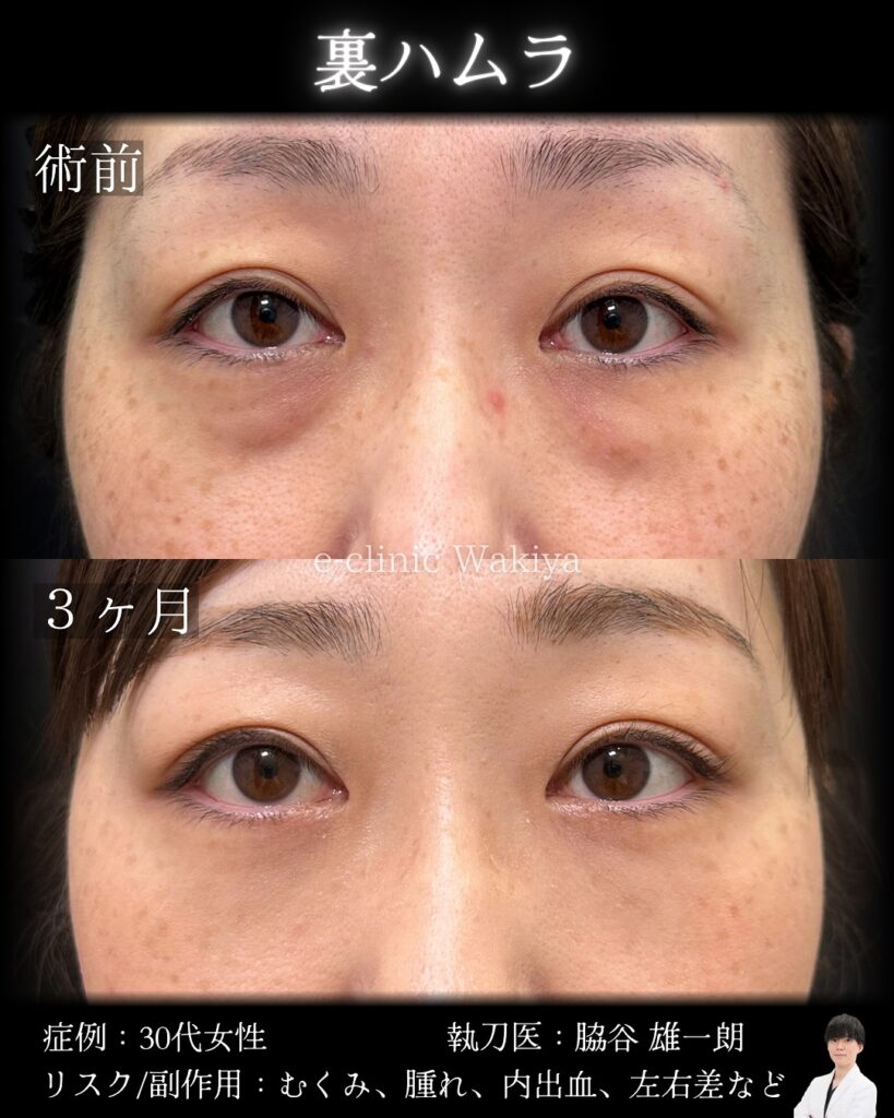 裏ハムラ法の症例写真 (3)