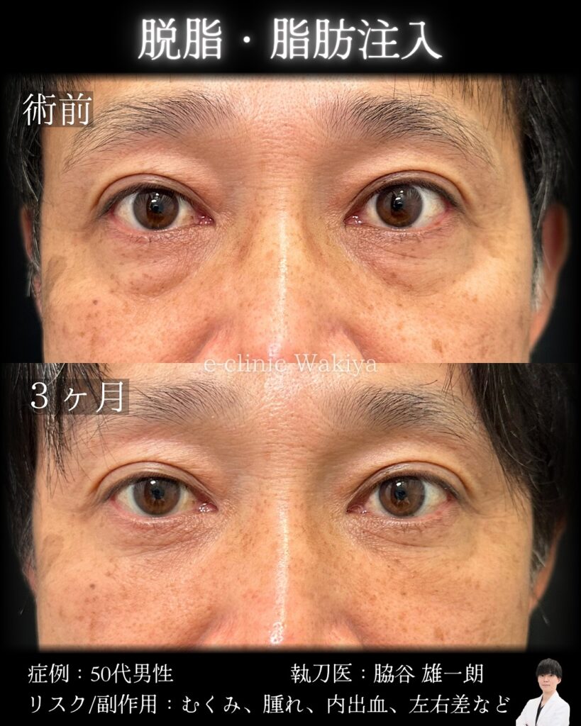 脱脂と脂肪注入の症例写真 (2)