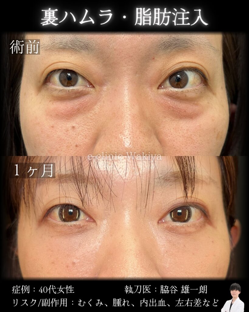 裏ハムラ法と脂肪注入の症例写真 (2)