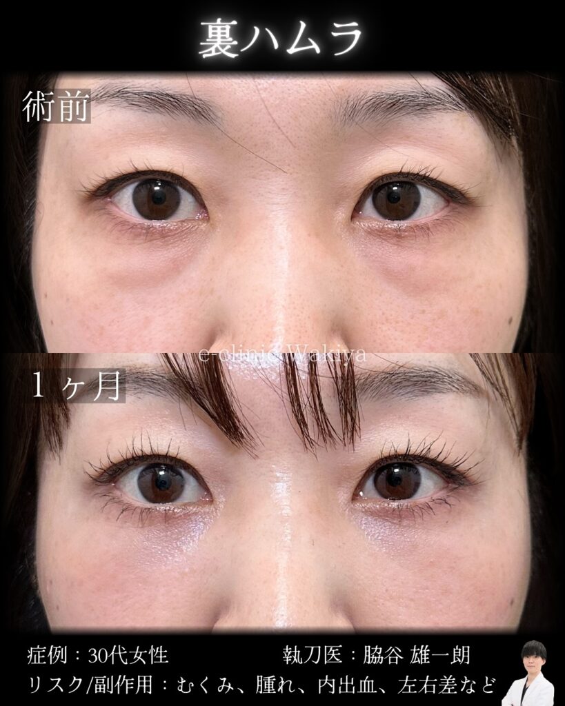 裏ハムラ法の症例写真 (1)