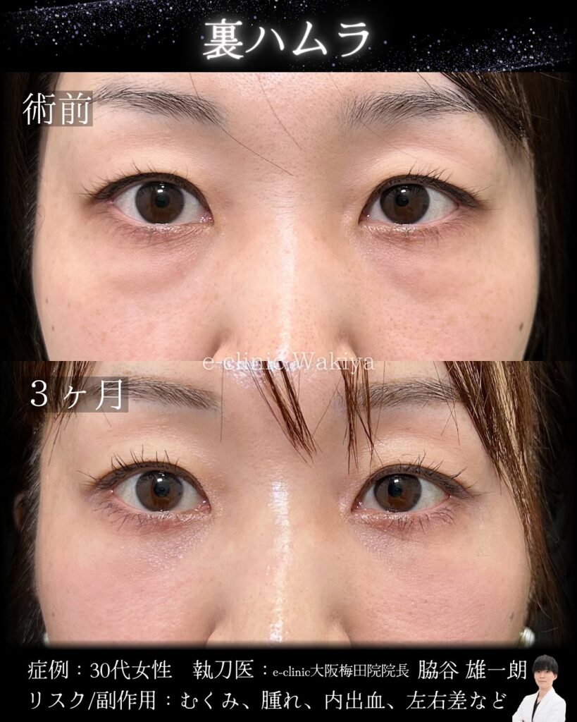 裏ハムラ法の症例写真