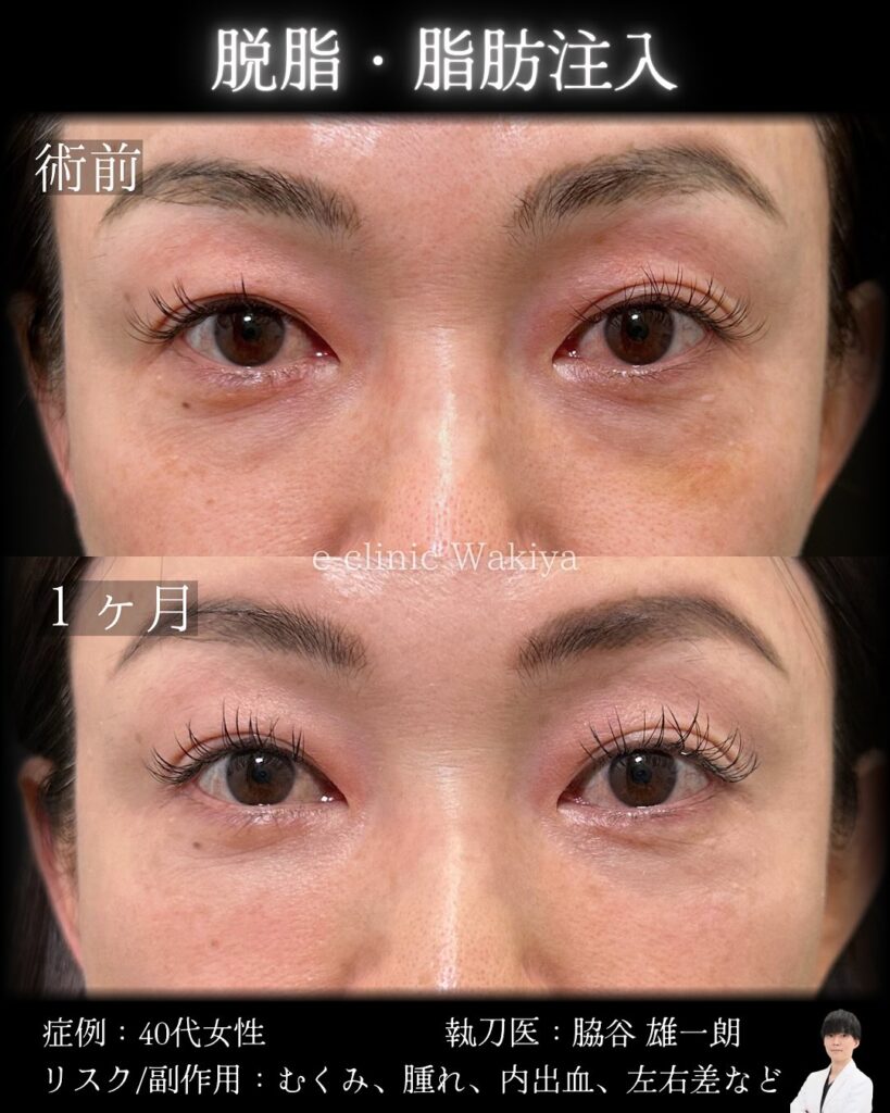 脱脂と脂肪注入の症例写真