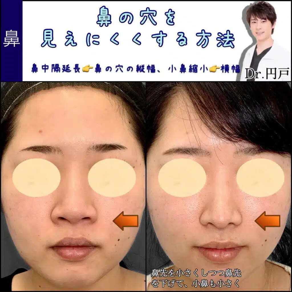 鼻中隔延長　小鼻縮小　大阪梅田