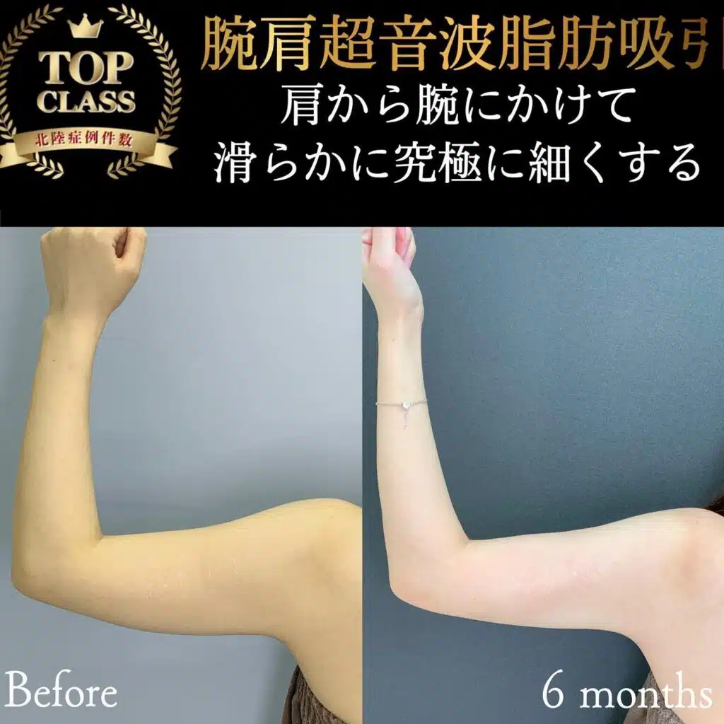 腕肩超音波脂肪吸引　大阪梅田
