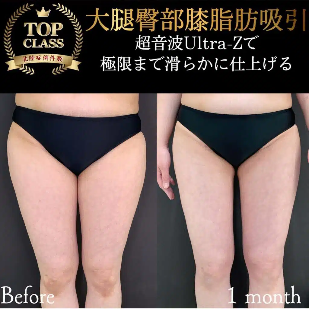 大腿臀部膝脂肪吸引　大阪梅田